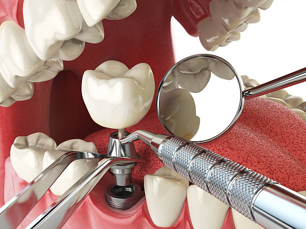 Best Emergency Root Canal Treatment in New California, OH